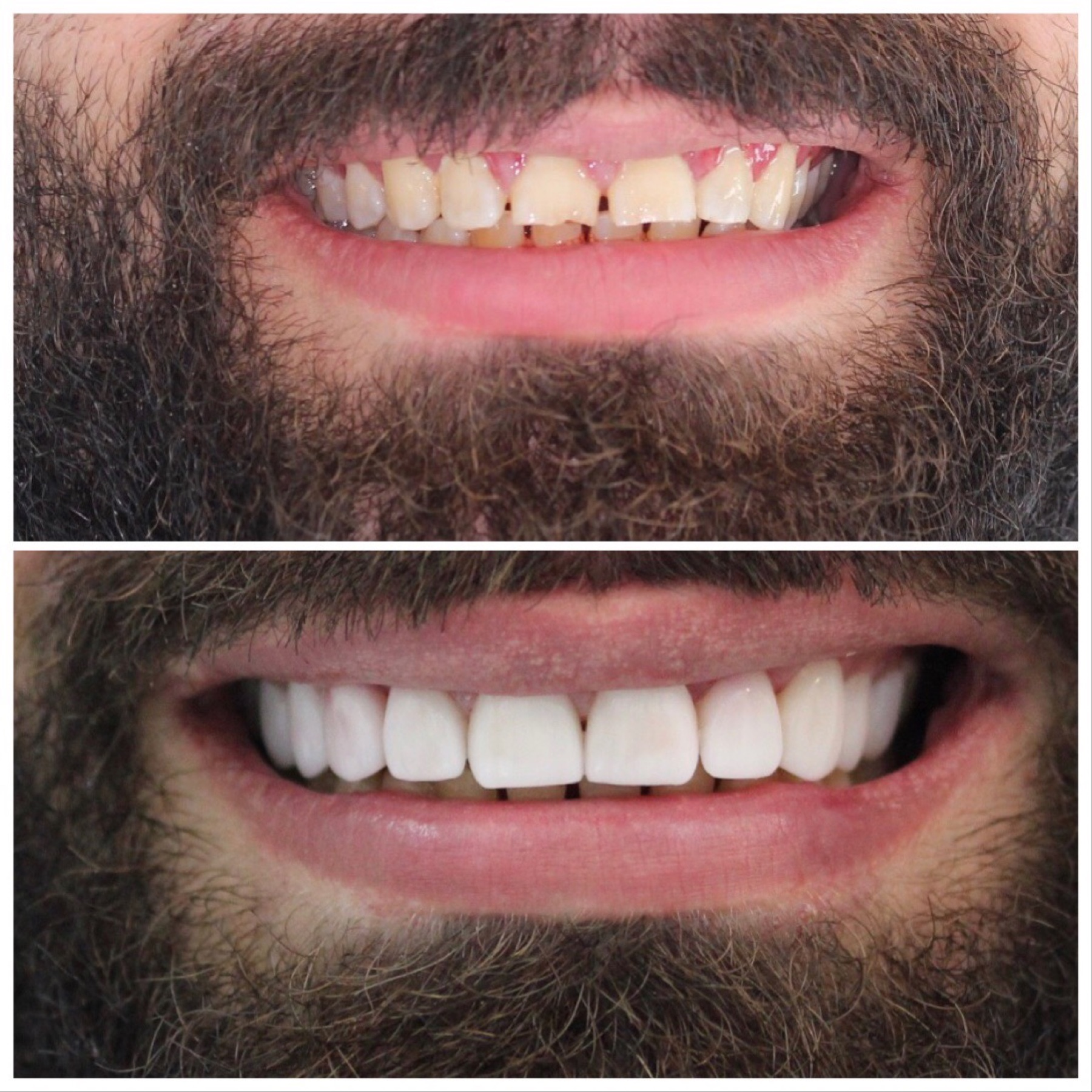 Zirconia bridges restoring missing teeth
