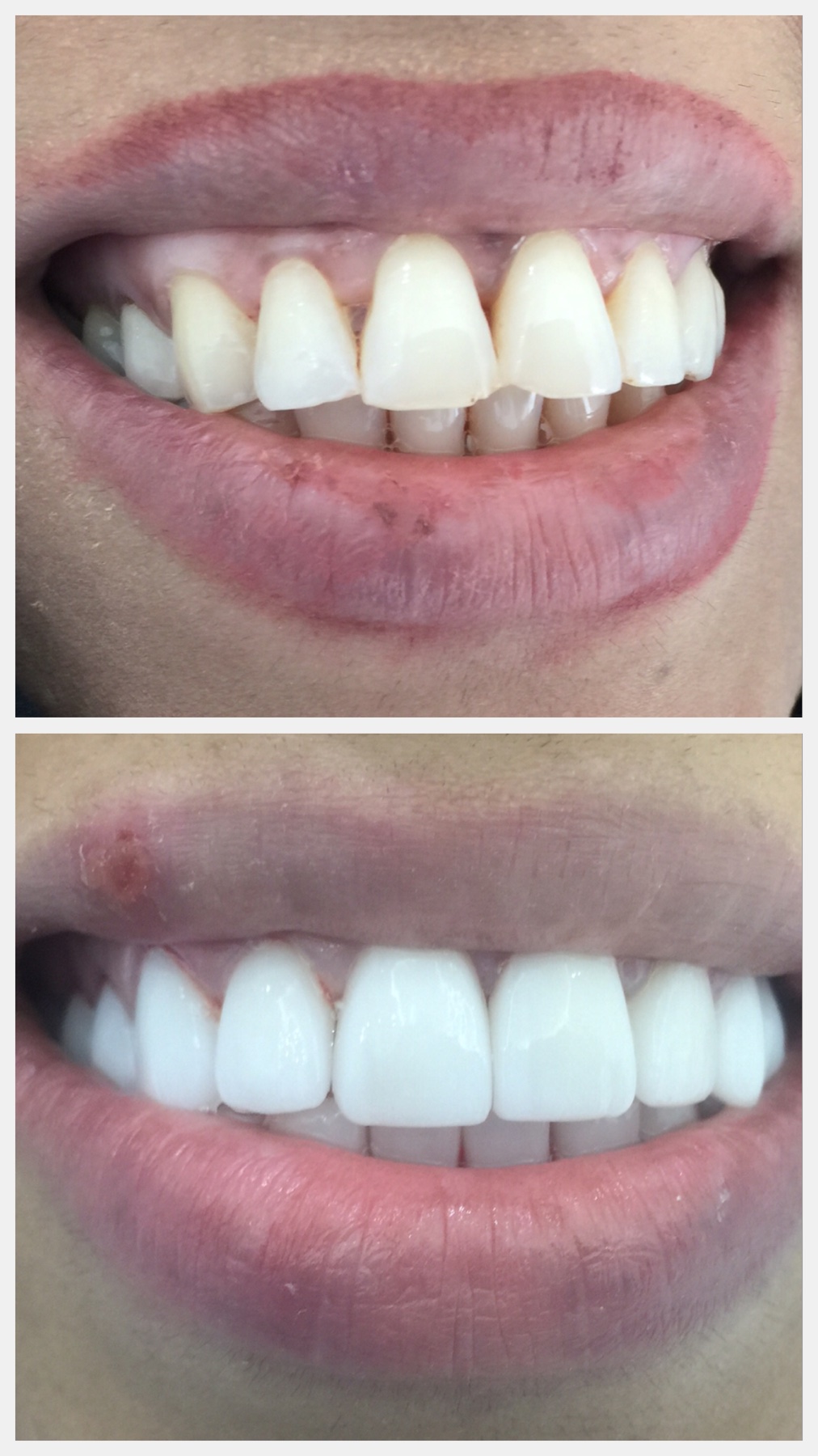 Front-tooth veneers — closed gap, brighter shade